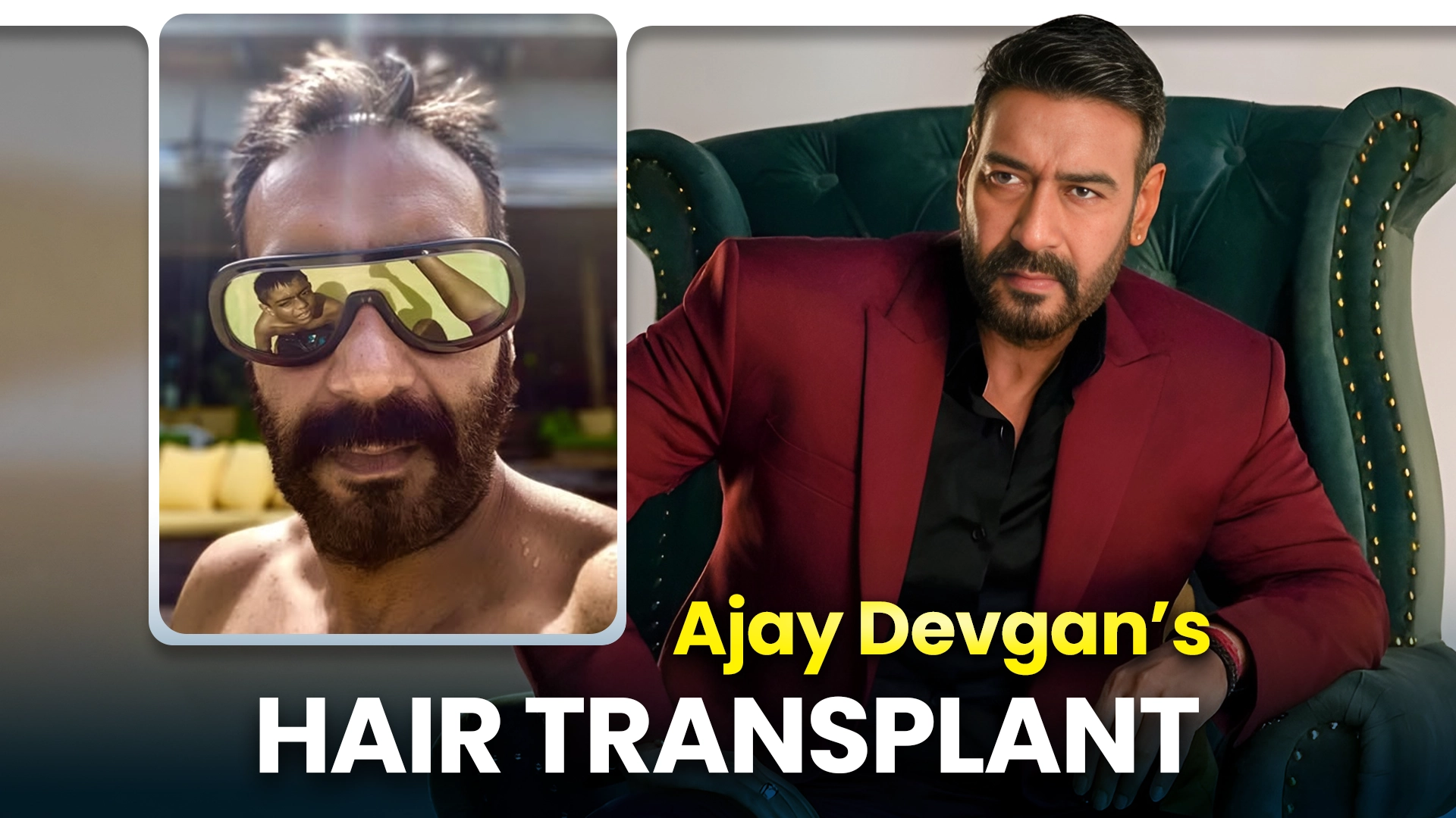 Ajay Devgan Hair Transplant