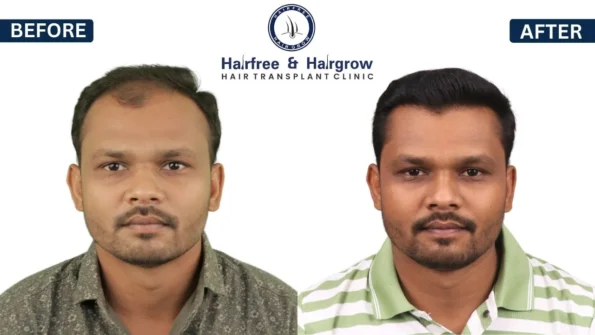 Before after hair transplant result in India
