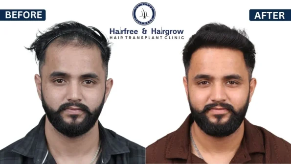DHI hair transplant Result