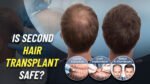 Is second hair transplant safe