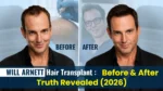 Will Arnett hair transplant before and after comparison showing hairline restoration and hair transformation results in 2026