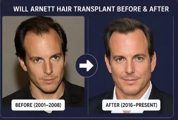 Will Arnett Hair Transplant before after