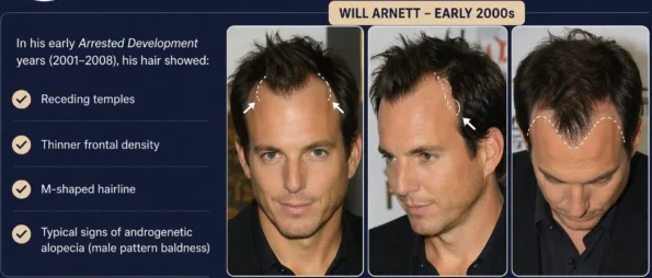 will arnett hair loss journey
