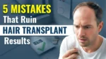 Mistakes That Ruin Hair Transplant Results