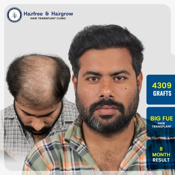 Hair Transplant results, before after hair transformation