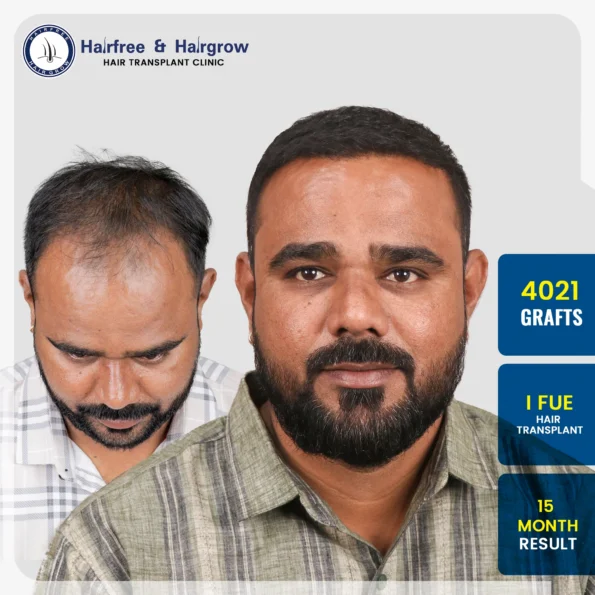 hair transplant successful results