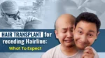 Hair transplant treatment for receding hairline with before and after hair restoration results