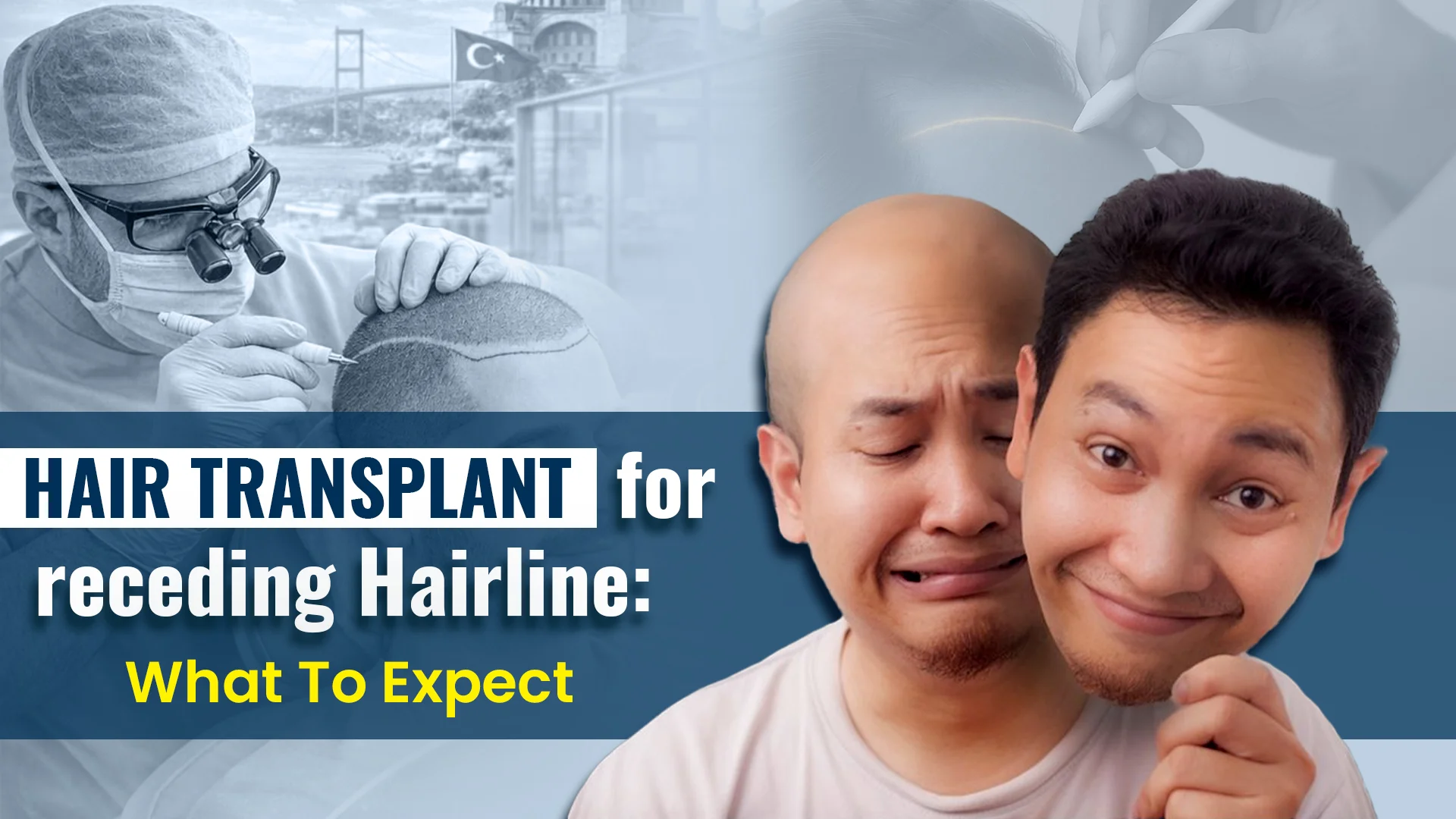 Hair transplant treatment for receding hairline with before and after hair restoration results
