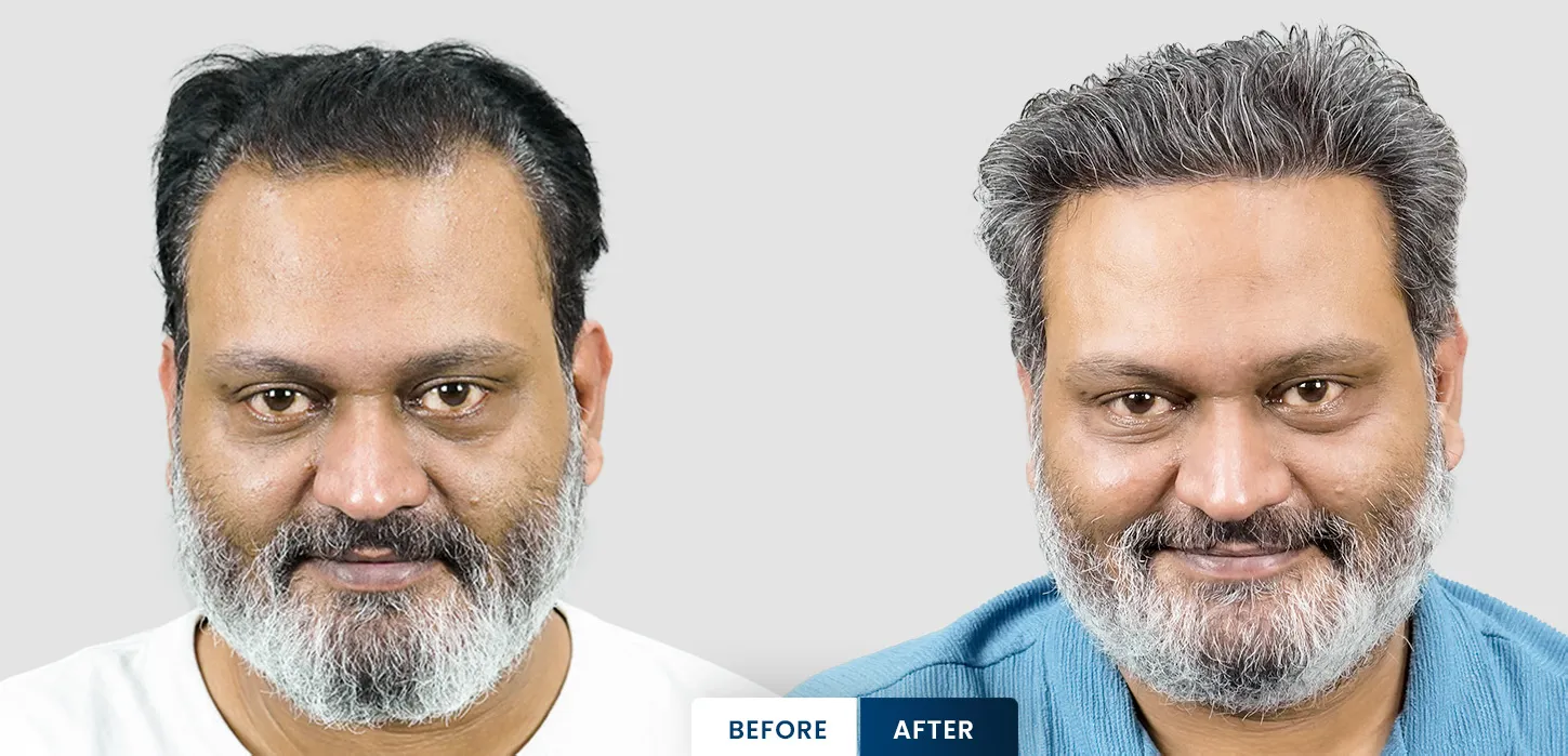 Arjun Rana celebrity hair transplant results