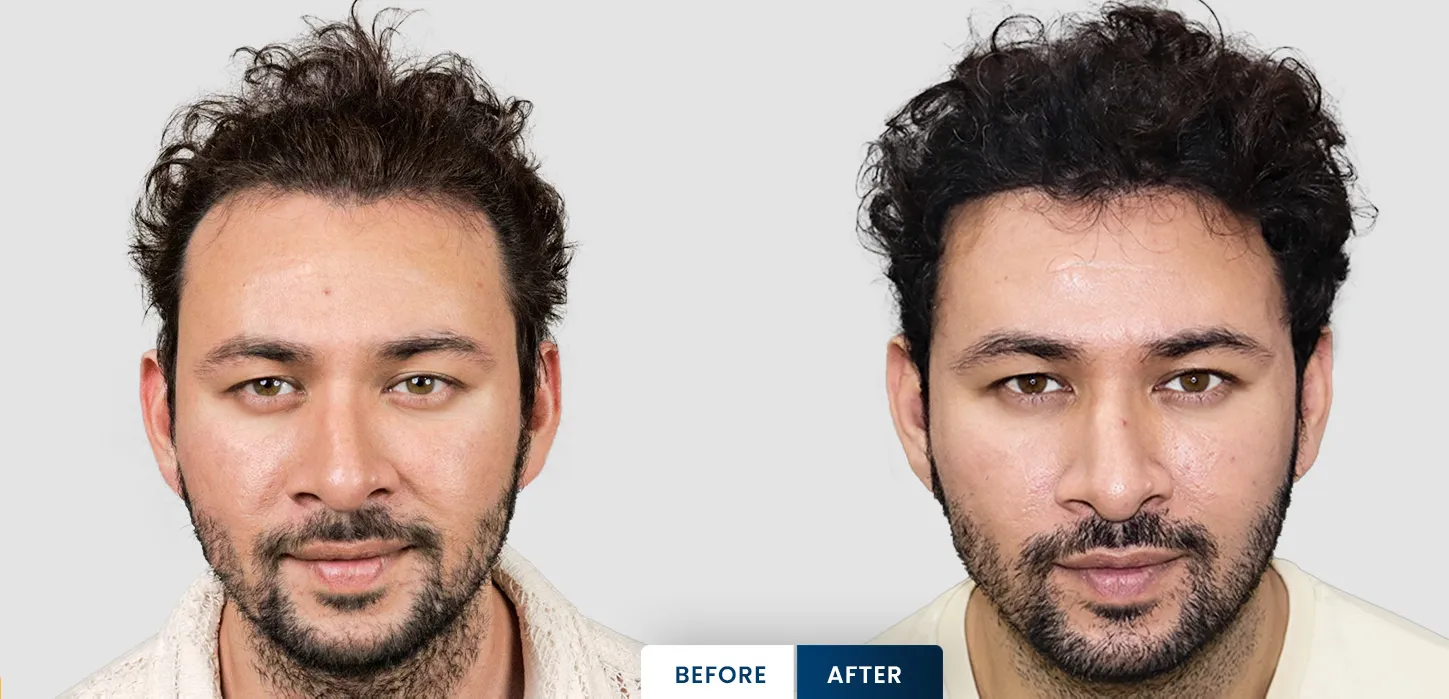 Dev Sharma hair transplant result