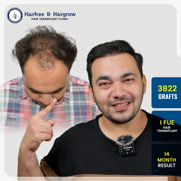 3822 grafts FUE hair transplant 14 month result for receding hairline restoration