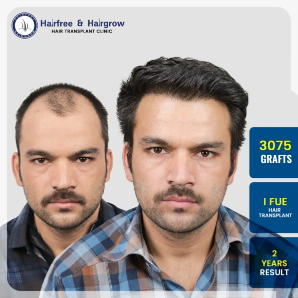 Before and after FUE hair transplant result showing 3075 grafts with natural hairline restoration after 2 years at Hairfree Hairgrow Clinic