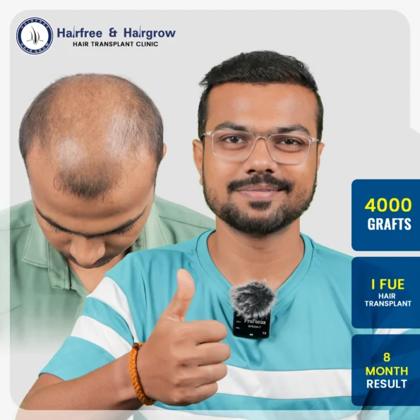 4000 graft I-FUE hair transplant 8 month result at Hairfree Hairgrow showing natural hair density improvement