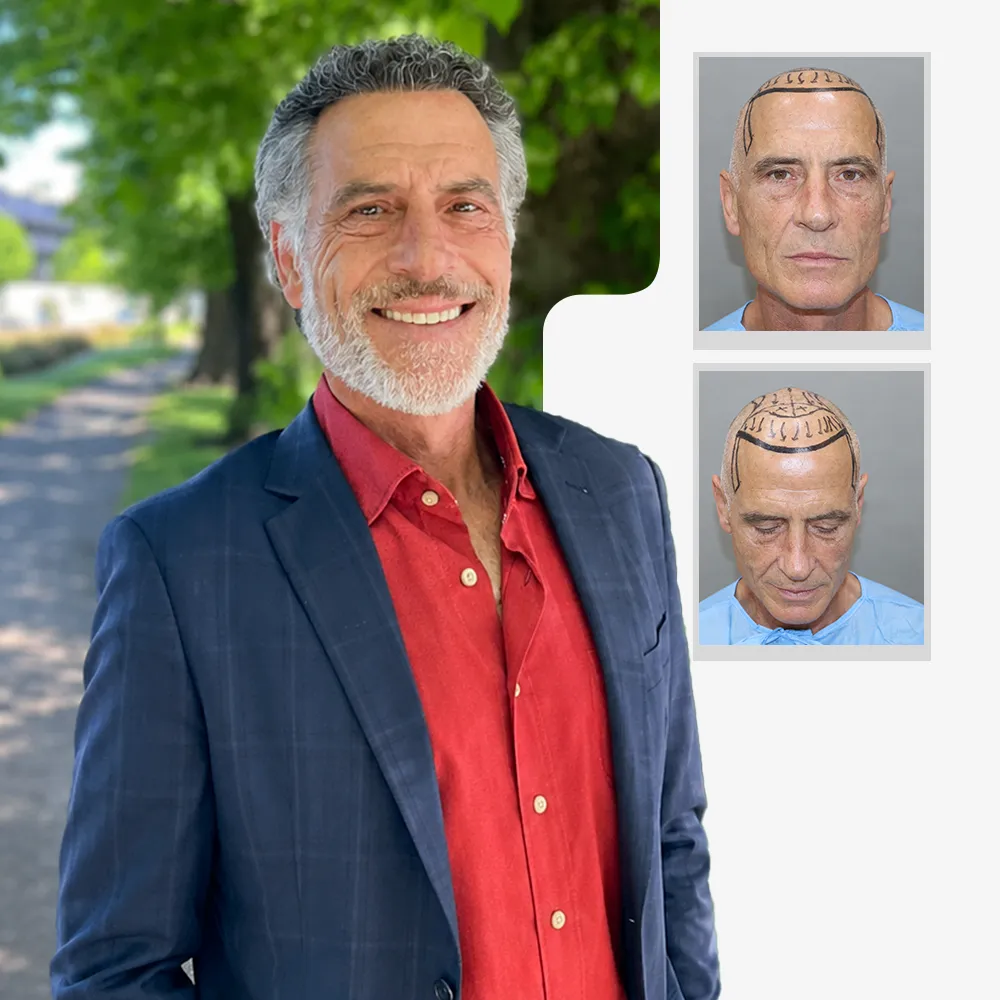 International patient hair transplant before and after result