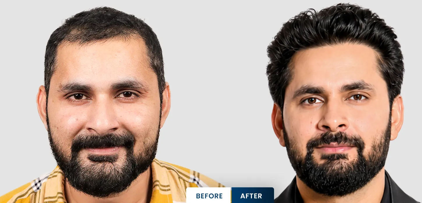 Sajid Shahid hair transplant before and after
