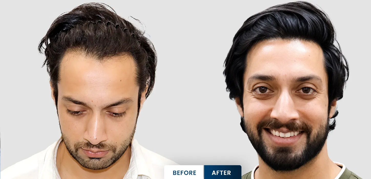 Salman Shaikh hair transplant before and after
