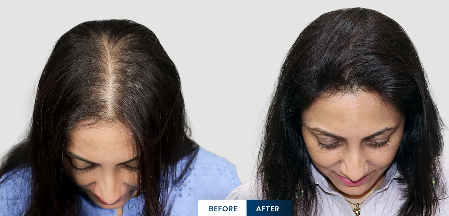 Vandana Lalwani celebrity hair transplant