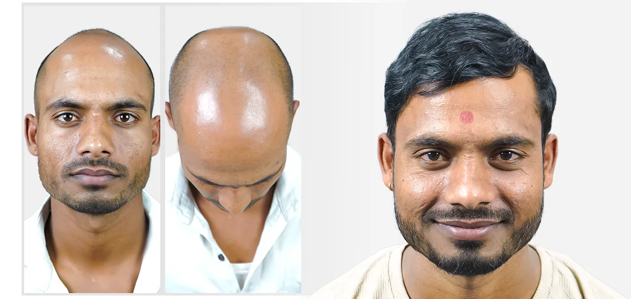 Hair transplant in Pune before and after results showing restored frontal hairline and improved density