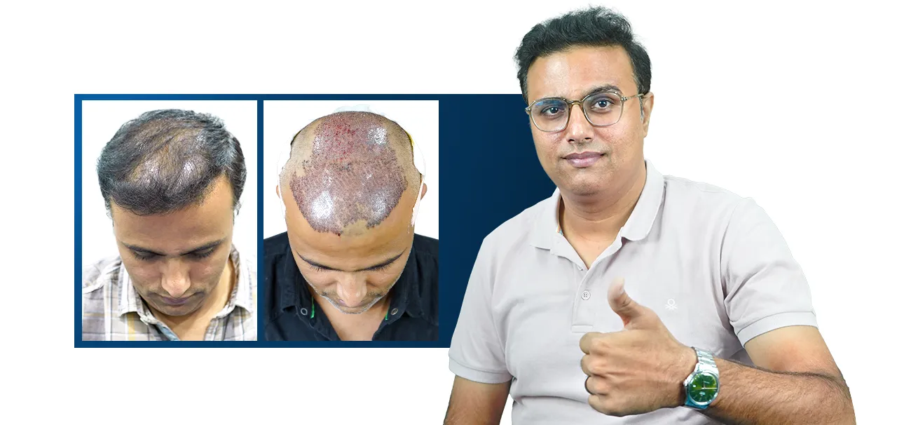 Before and after hair transplant in Pune demonstrating natural hair growth and fuller coverage