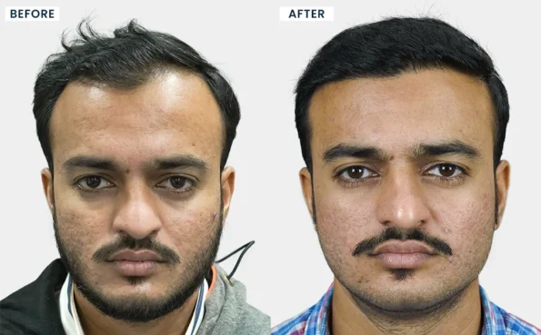 Hair transplant in Pune before and after results showing improved hairline and density