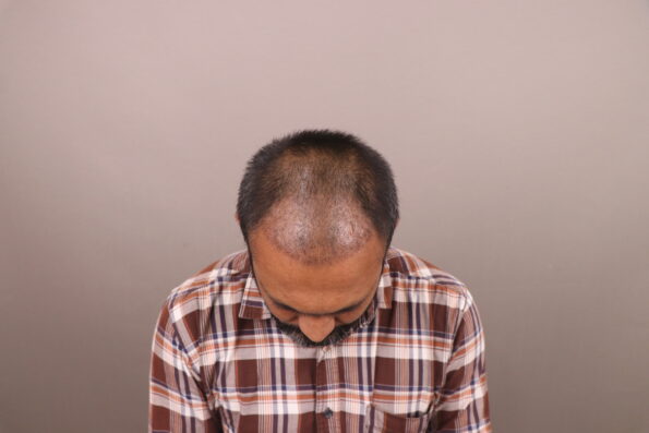 Grade 3 Baldness Hair Transplant 1 Month 7 Days Recovery