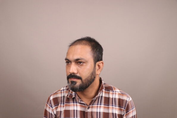 Grade 3 Baldness Hair Transplant 2 Months 7 Days Recovery