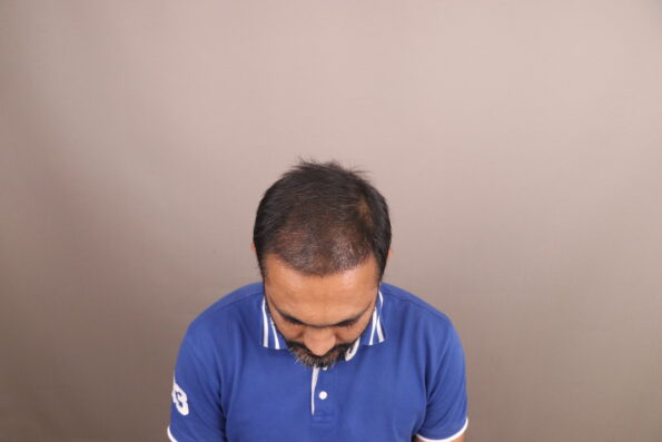 Grade 3 Baldness Hair Transplant 3 months after Bio-FUE surgery showing the first signs of new hair growth along the hairline and temples.