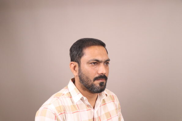Grade 3 Baldness Hair Transplant 4 Months Recovery
