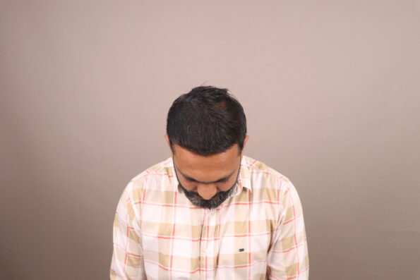 Grade 3 Baldness Hair Transplant 7 Months Recovery
