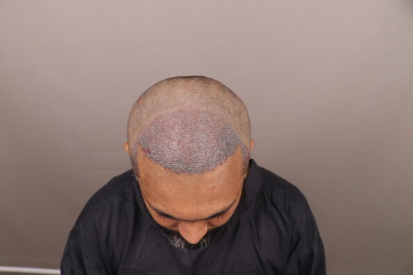 Grade 3 Baldness Hair Transplant immediately after the Bio-FUE procedure showing newly implanted grafts across the hairline and temples.