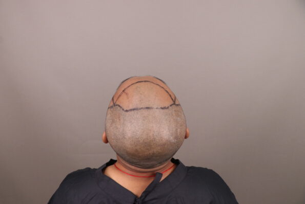 Grade 3 Baldness Hair Transplant After Donor Area Trimming