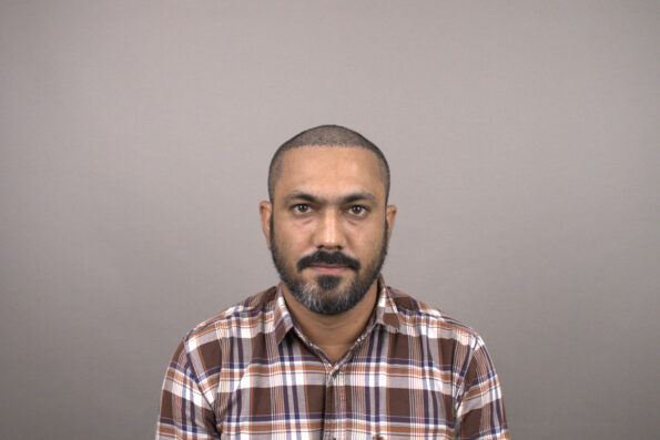 Grade 3 Baldness Hair Transplant Day 7 showing early healing, reduced redness, and healthy graft settling after the Bio-FUE procedure.