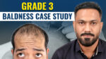 Grade 3 baldness case study showing a man with moderate hair loss before a hair transplant alongside his post-treatment appearance, illustrating hair restoration planning for Norwood Grade 3 baldness.