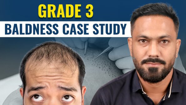Grade 3 baldness case study showing a man with moderate hair loss before a hair transplant alongside his post-treatment appearance, illustrating hair restoration planning for Norwood Grade 3 baldness.