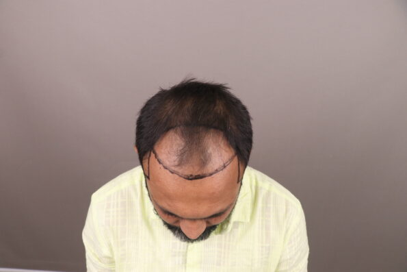 Grade 3 Baldness Hair Transplant hairline marking before Bio-FUE surgery to design a natural hairline and plan graft placement.