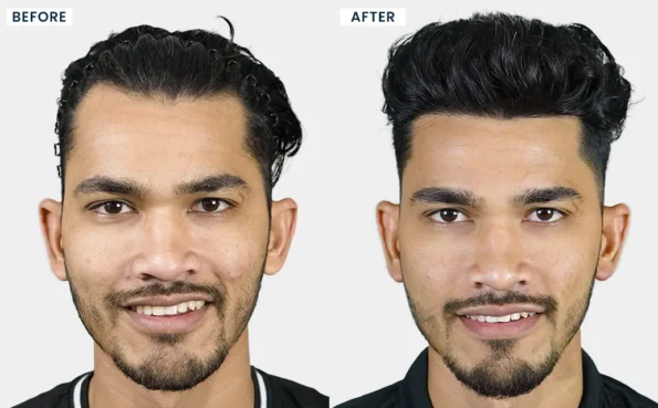 Successful hair transplant in Pune before and after comparison for male pattern baldness