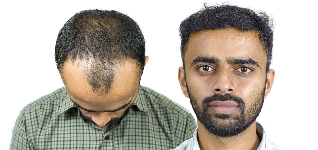 Successful hair transplant in Pune before and after transformation for male pattern baldness