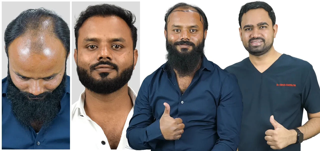 Hair restoration results after hair transplant in Pune showing enhanced hairline and scalp coverage