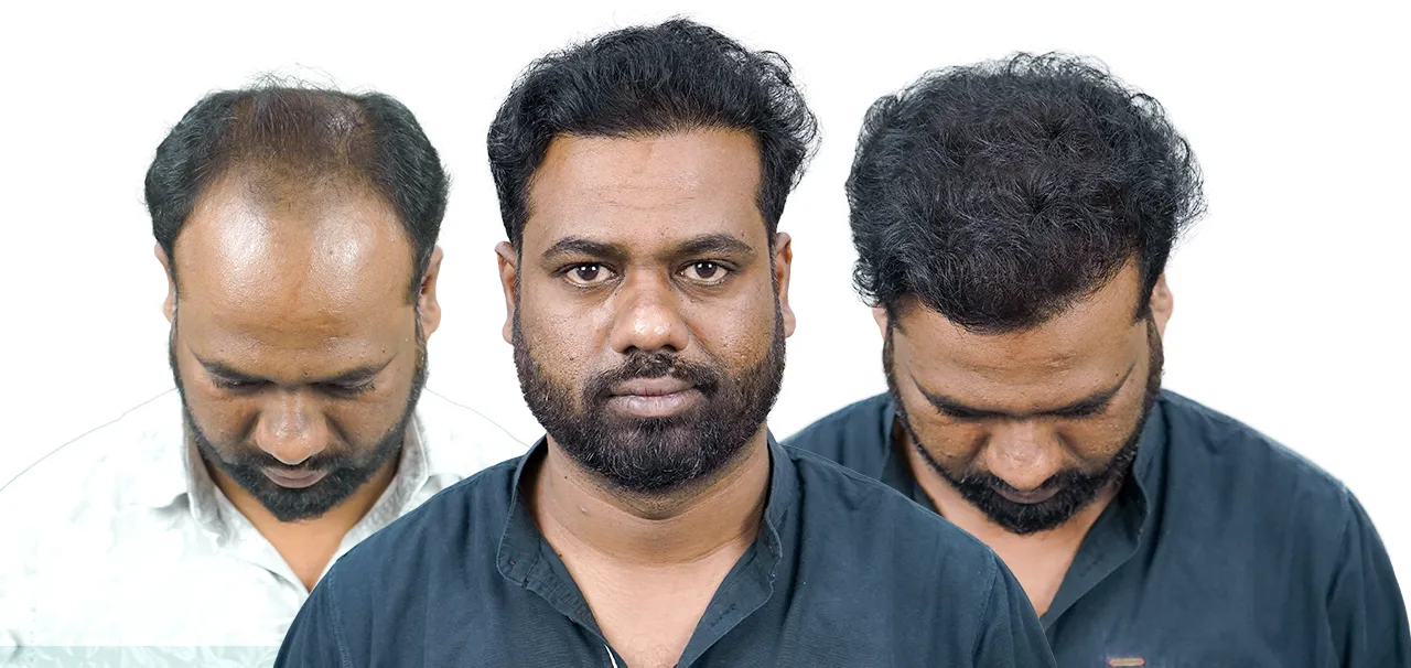 Patient before and after hair transplant in Pune with noticeable improvement in hair density and appearance