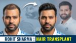 Rohit Sharma hair transplant journey showcasing a fuller hairline after visible hair restoration