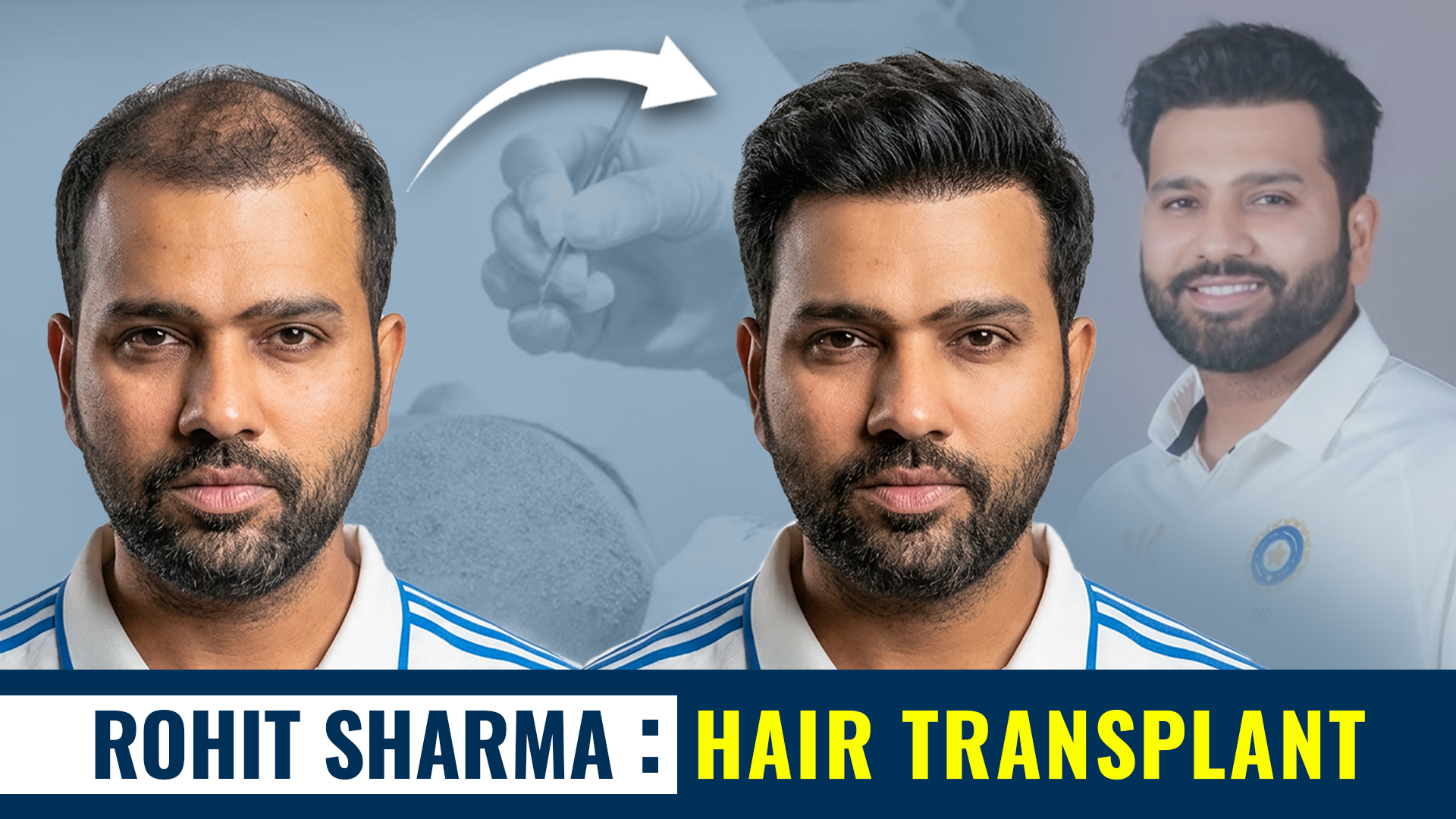 Rohit Sharma showcasing a fuller hairline after visible hair restoration transformation