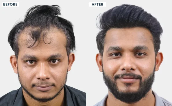 Patient transformation after hair transplant in Pune showing fuller hair growth