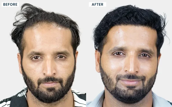 Before and after hair transplant in Pune with natural-looking hair restoration results