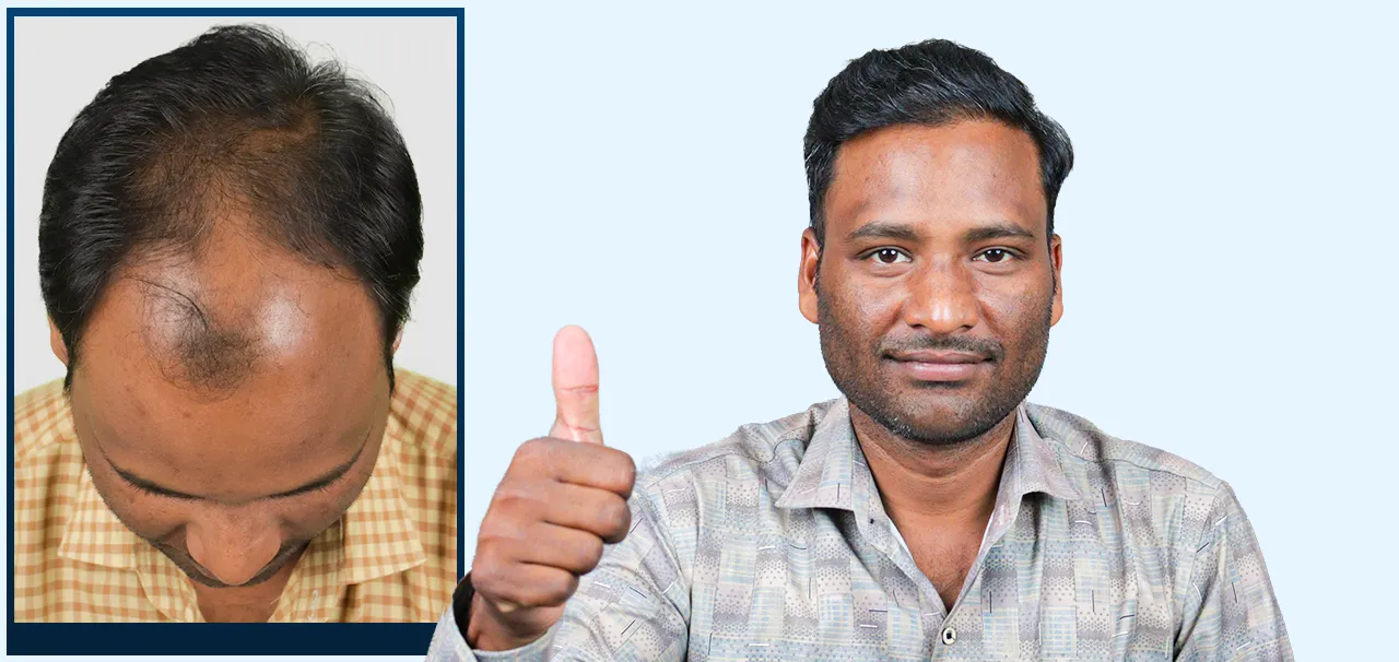Patient sharing successful FUE hair transplant result in Surat