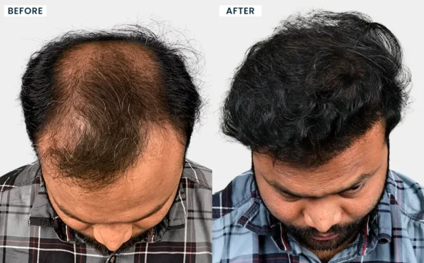 Before and after FUE hair transplant result for crown baldness treatment in Surat