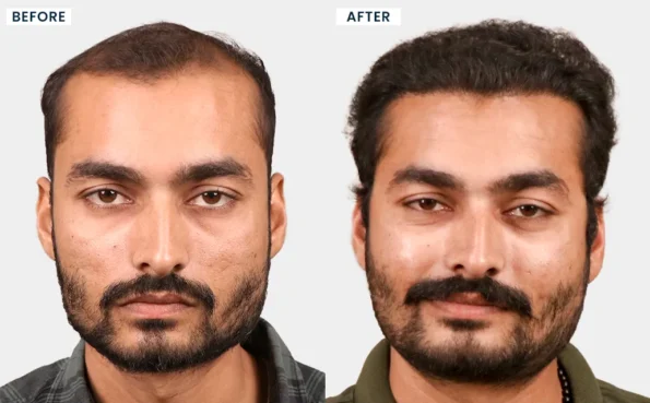 Before and after natural hairline restoration with FUE hair transplant in Surat