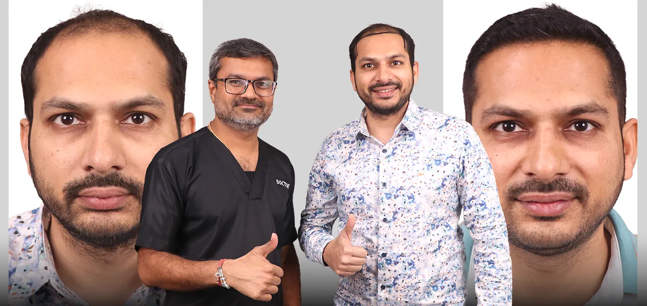 Hair transplant patient showing natural hair restoration result in Surat