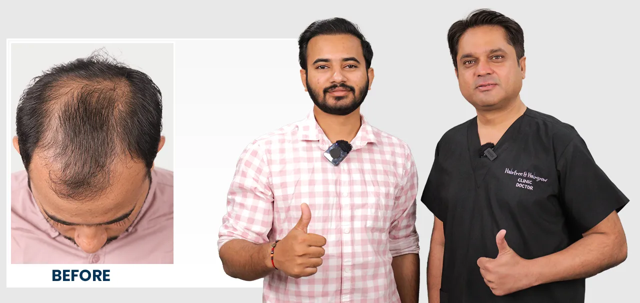 Before and after hair transplant result with patient and doctors in Surat
