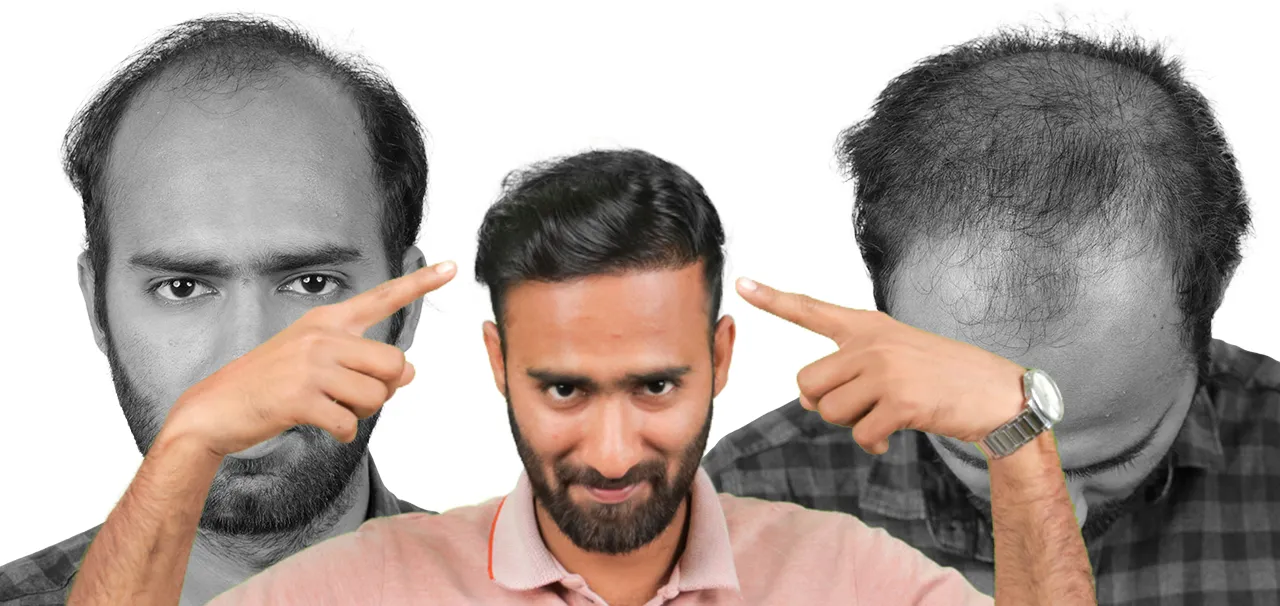 Patient showing natural hair growth after hair transplant in Surat
