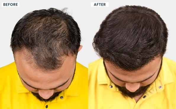 Before and after hair transplant results of ARWAJ MANSURI showing improved hair density and a natural-looking hairline at HairFree HairGrow Vapi